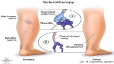 Skleroterapi Tedavisi İşe Yarar Mı?